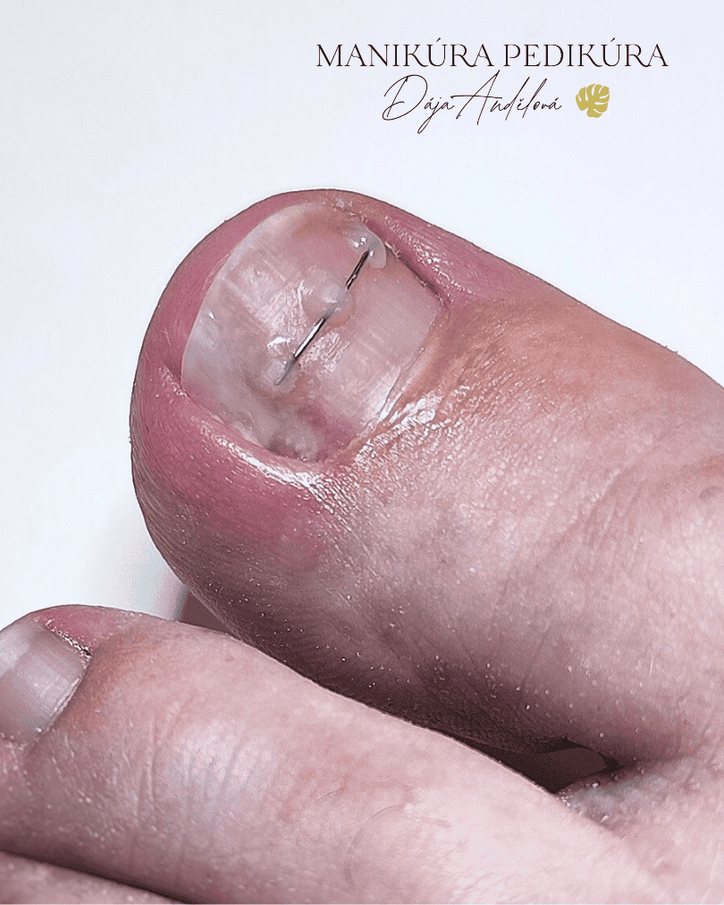 Nehtove rovnatko NiTi titanova nit zarustajici nehet